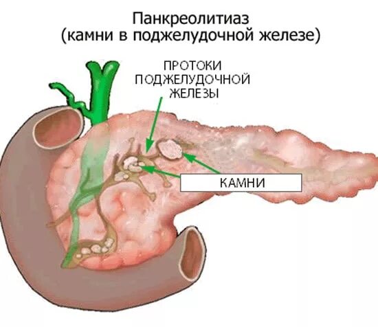 Поджелудочная железа панкреатит операция. Камень протока поджелудочной железы. Конкремент в протоке поджелудочной железы. Камни в протоках поджелудочной железы. Камни в поджелудочной железе операция.