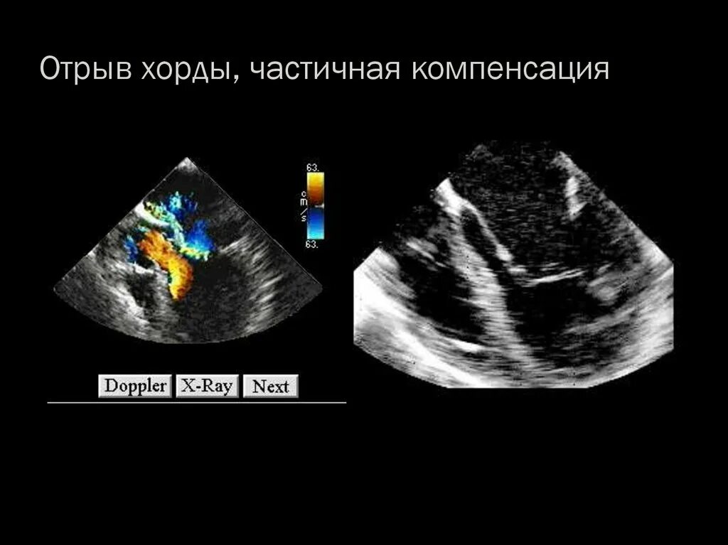 Частичный отрыв. Отрыв хорды митрального клапана эхокг. хорды передней створки митрального клапана. отрыв хорды передней створки митрального клапана. отрыв хорды митрального клапана на узи.