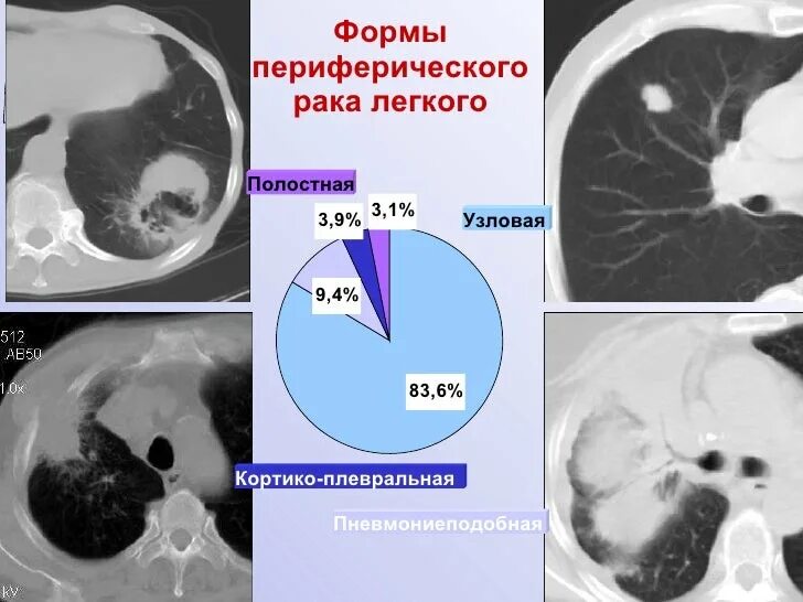 Периферические опухоли легких. Периферическое новообразование легкого. Периферическая опухоль легкого. Периферическое образование легких на кт. Полостные образования в легких