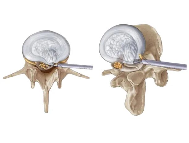 Эндоскопическая дискэктомия грыжи позвоночника. Операция межпозвоночной грыжи микродискэктомия. Микродискэктомия грыжи позвоночника поясничного отдела. Микроэндоскопическая дискэктомия. После операция грыжа диска