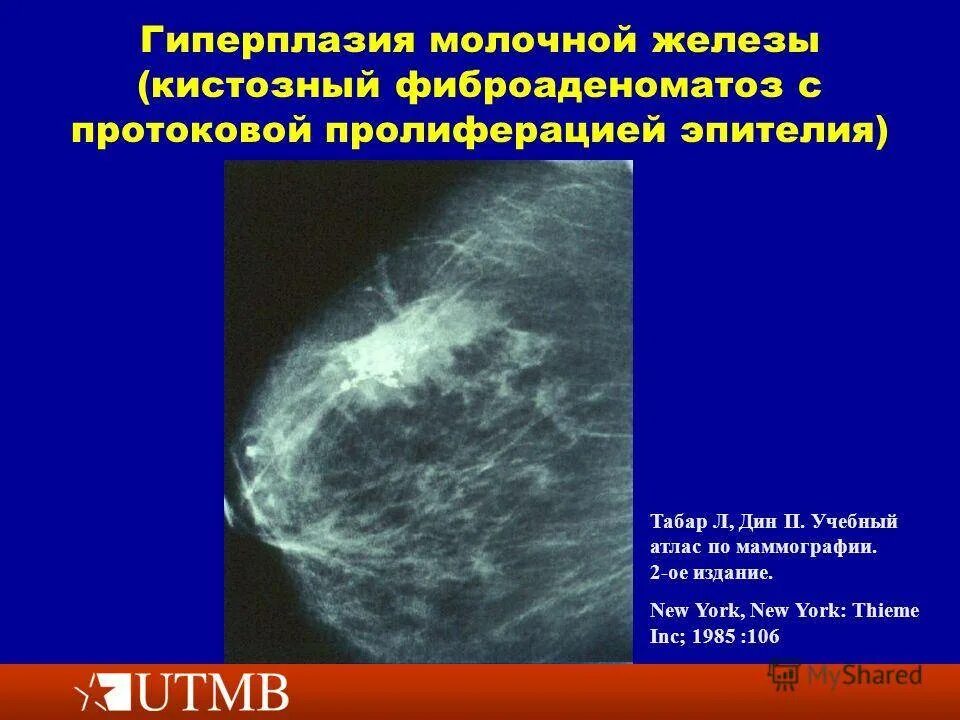Гиперплазия железистой ткани молочной железы. Узловая гиперплазия железистой ткани молочной железы. Фиброзно кистозная фиброаденоматоз молочной железы. Мастопатия на маммографии.