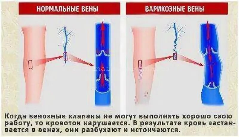 Диета при тромбозе глубоких вен