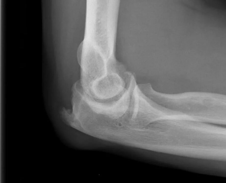 Блоковидная вырезка локтевого сустава. Локтевой отросток локтевой кости болит. Сесамовидные кости локтевого сустава. Точки окостенения локтевого сустава. Ядра окостенения локтевого сустава.