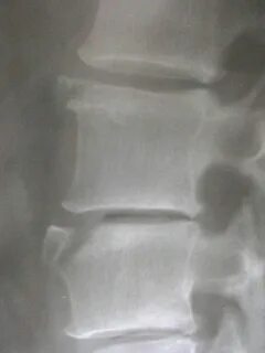 Остеофит народные средства