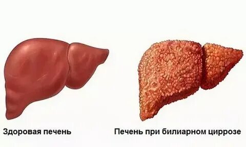Билиарный синдром печени