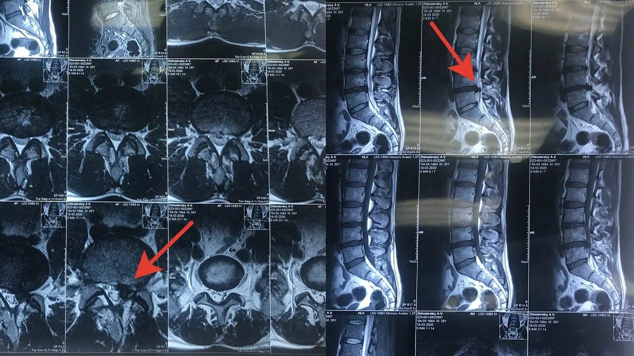 Транспедикулярная фиксация l5-s1. Резорбция межпозвонковой грыжи. Позвоночная грыжа операция. После операция грыжа диска