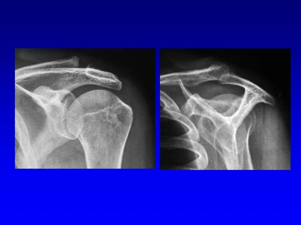 Разрыв капсулы плечевого сустава рентген. Разрыв суставной капсулы плечевого сустава. Повреждение суставной капсулы плечевого сустава. Суставная капсула плечевого сустава повреждена.