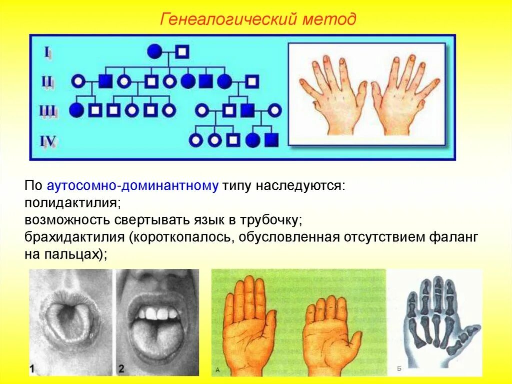 Полидактилия Тип наследования. Тип наследования при полидактилии. По аутосомно-доминантному типу наследуется. Полидактилия генетика.