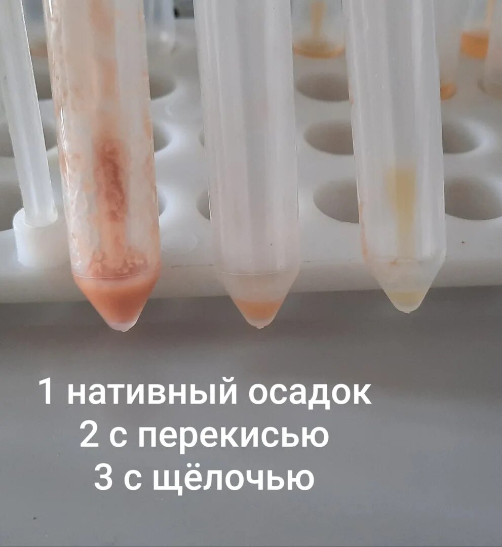 Осадок мочи в пробирке. Осадки мочи в пробирках. Осадки в моче в пробирке. Соли мочекислого аммония в моче. В пробирки с пероксидом водорода