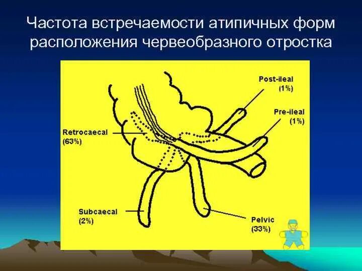 Расположение червеобразного отростка. Забрюшинное расположение червеобразного отростка. Типы расположения червеобразного отростка. Атипичные положения червеобразного отростка.