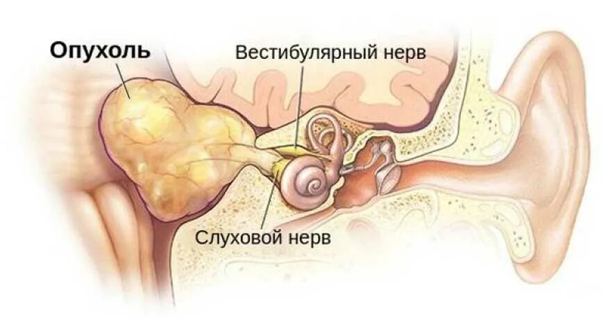 Поражение слухового нерва. Кохлеарный неврит слухового нерва. Невринома слухового нерва опухоль. Нейропатия слухового нерва. Слуховой нерв и вестибулярный нерв.