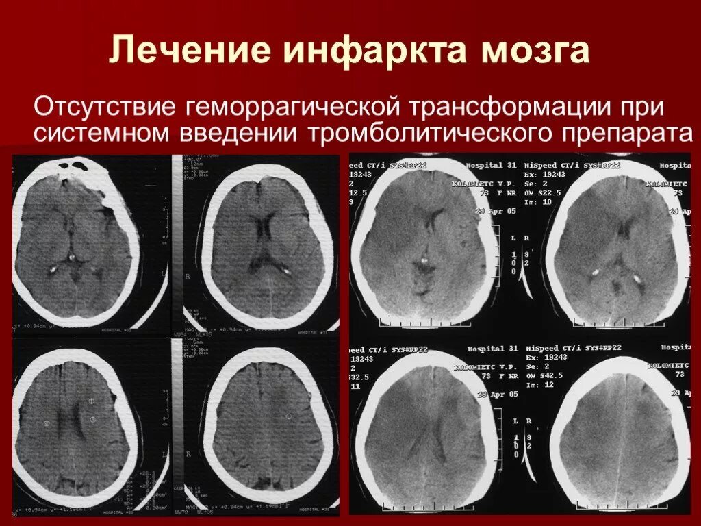 Инфаркт мозга неуточненный. Инфаркт головного могза. Инфаркт головного мозга снимки. Инфаркт с геморрагической трансформацией.