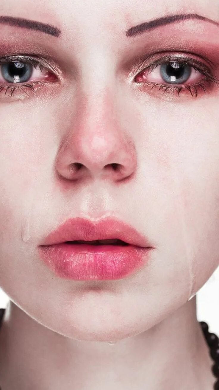 Розацеа телеангиэктазии. Гнейс атопический дерматит. Болезненный вид девушка. Болезненный вид кожи. Болезненная бледность кожи.