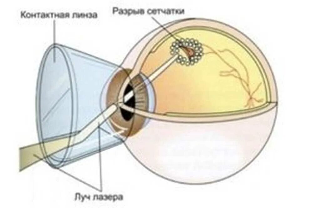 Ограничительная лазеркоагуляция сетчатки глаза. Линза для лазерной коагуляции сетчатки. Периферическая лазеркоагуляция сетчатки глаза. Приваривание лазером отслоившейся сетчатки глаза.