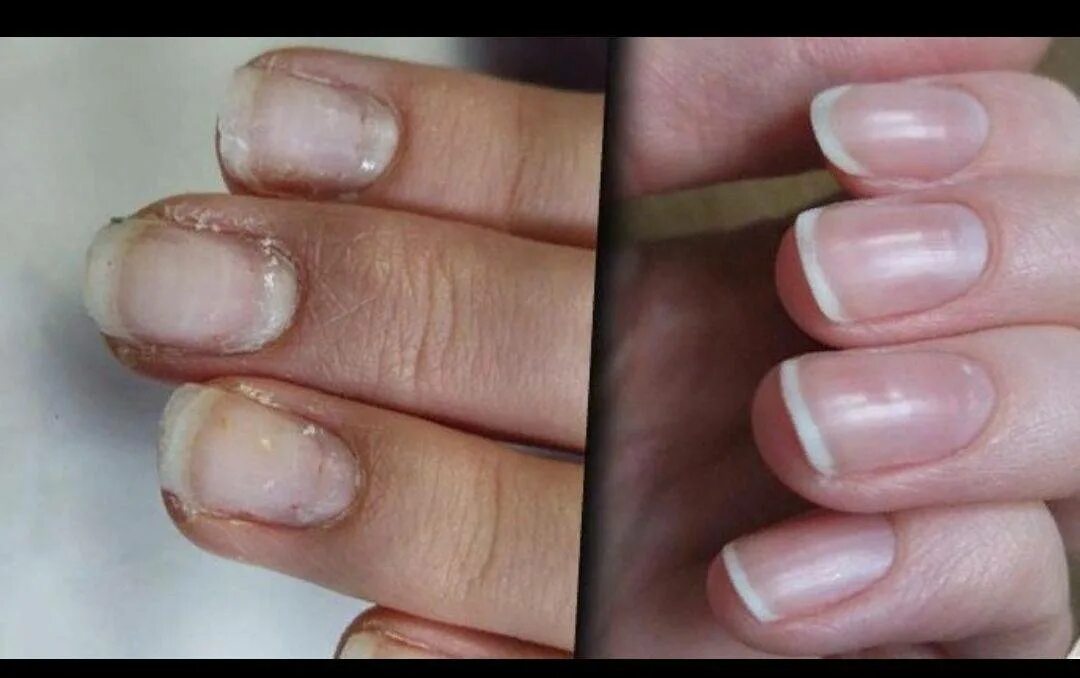 Быстро восстановить ногти после геля. Ногти после снятия гель лака. Восстановление ногтевой пластины. Ногтевая пластина после гель лака.