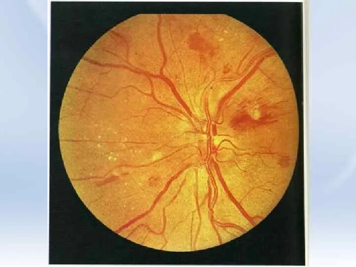 Болезнь глазного дна. Гипертоническая ангиопатия и ретинопатия. Гипертоническая ретинопатия офтальмоскопия. Ангиопатия сетчатки глазное дно. Почечная гипертоническая ретинопатия.