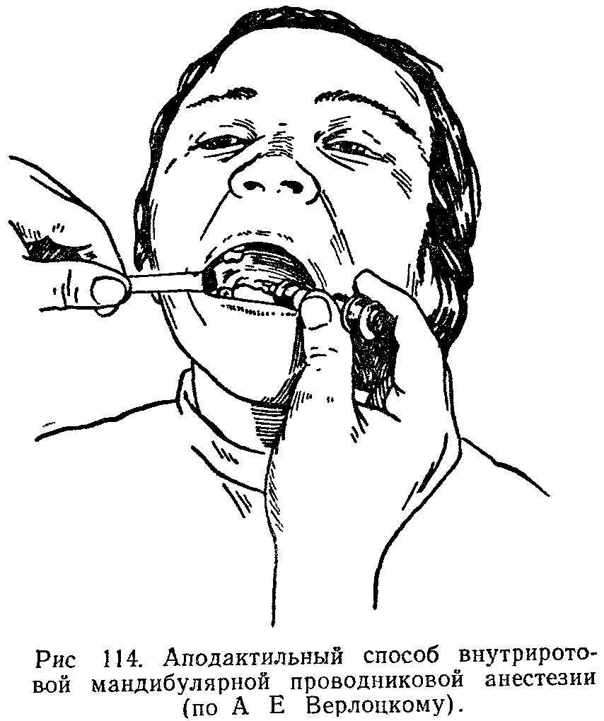 Анестезия полости рта. Аподактильный способ мандибулярной анестезии. Проводниковая анестезия нижней челюсти торусальная. Мандибулярная анестезия аподактильный метод схема. Мандибулярная анестезия методика.