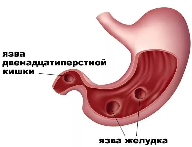 Салфетки язвы