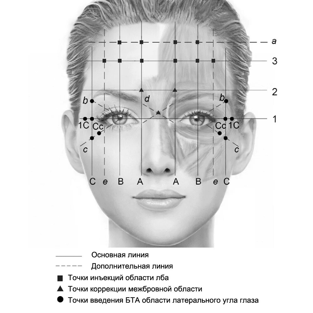 Точки введения диспорта на лице схема. Схемы для ботулотоксина схема введения. Схема уколов диспорта. Схема введения ботокса на лице. Точка уколова