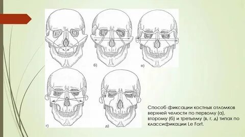 Переломы челюсти клинические рекомендации