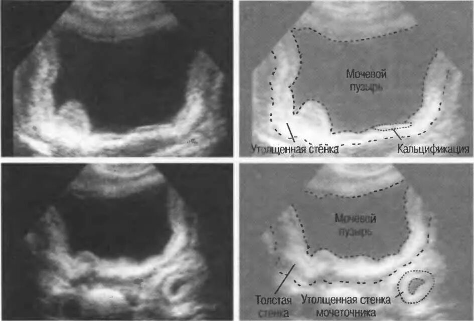 Утолщение мочевого пузыря у мужчин. Отслоение слизистой мочевого пузыря. Отслоение слизистой мочевого пузыря на УЗИ. Стенки мочевого пузыря утолщены УЗИ. Отслойка слизистой мочевого пузыря УЗИ.