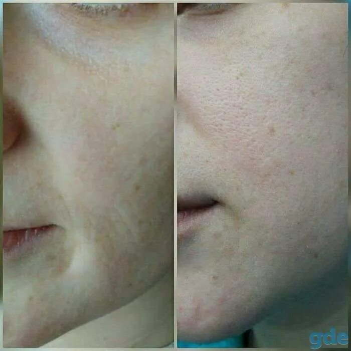 Обезвоженная проблемная кожа лица. Сухая обезвожегная крэа. Жирная обезвоженная кожа. Обезвоженная кожа лица фотосессия. Жирная обезвоженная кожа.