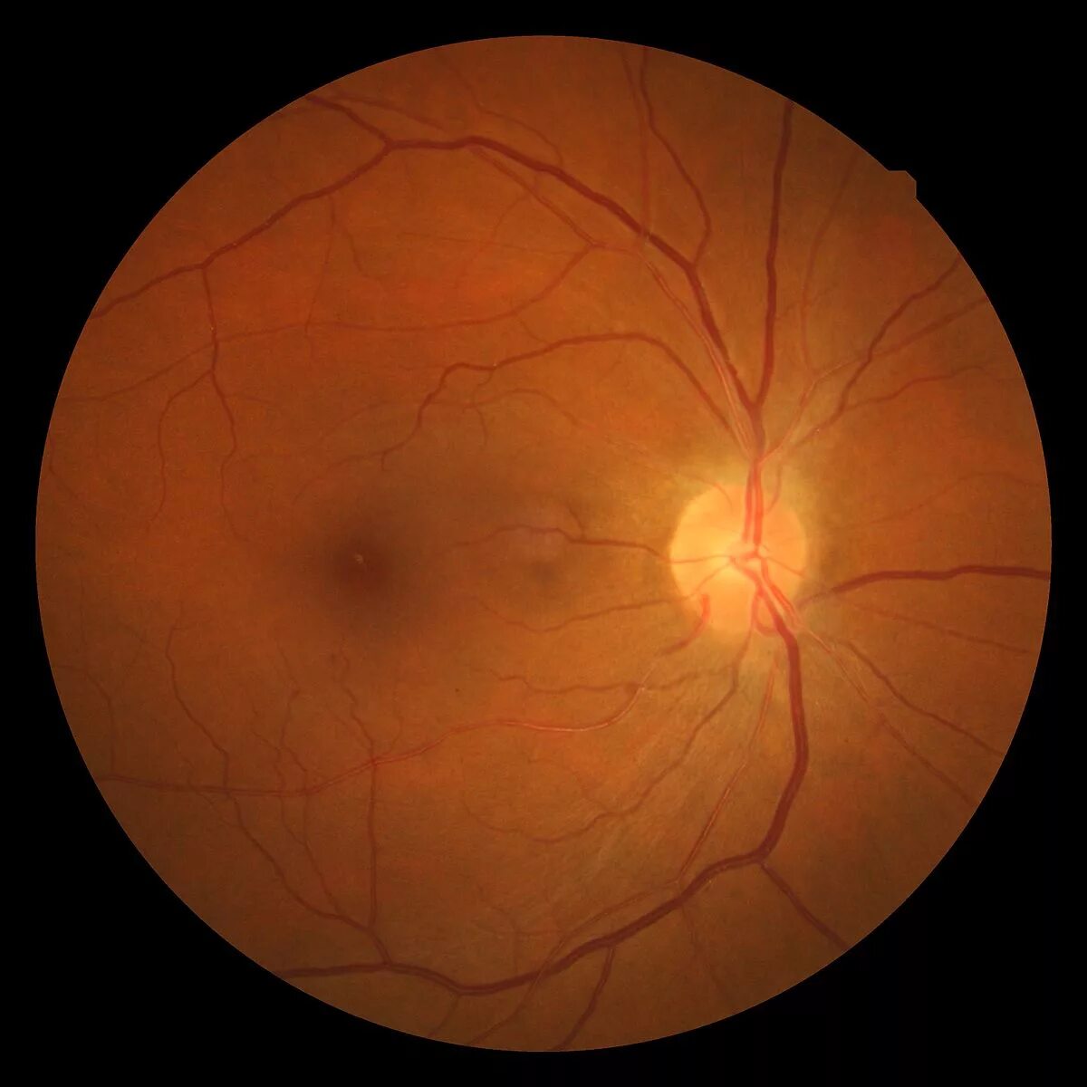 Гипертоническая ретинопатия глазное дно. Ангиоспастическая ретинопатия. Мкб колобома хориоидеи.