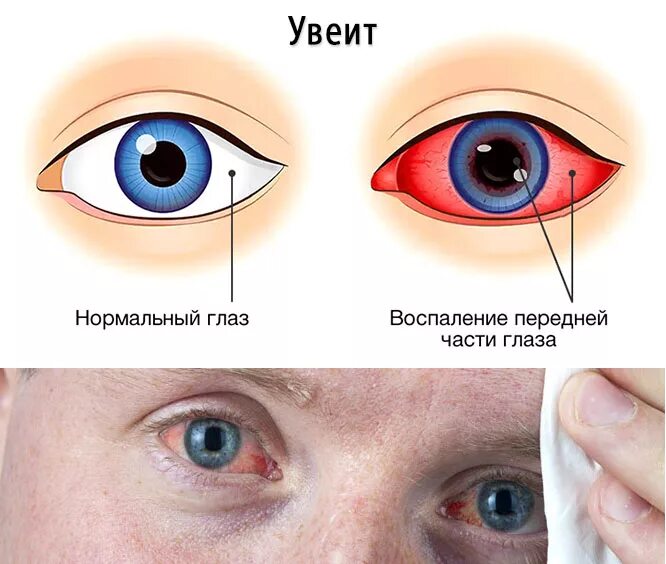 Кератит увеит иридоциклит. Увеит (воспаление сосудистой оболочки глаза).. Симптомы переднего увеита.