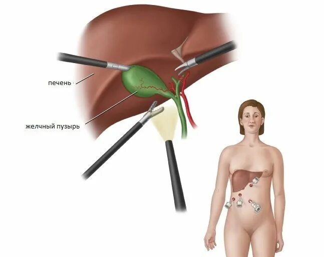 Можно печень после удаления желчного пузыря. Холецистит и лапароскопическая холецистэктомия. Холецистит лапароскопическая операция. Холецистэктомия лапароскопия. Лапароскопия желчного пузыря nhemrf катетер.