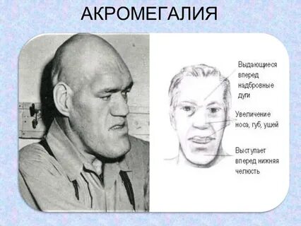 Надбровный