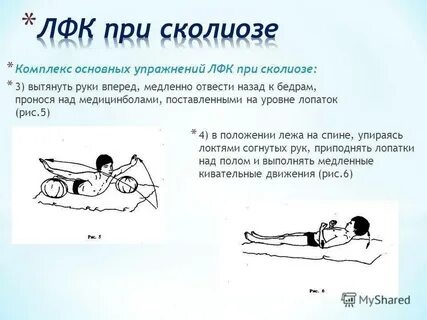 Физкультура при сколиозе 1 степени