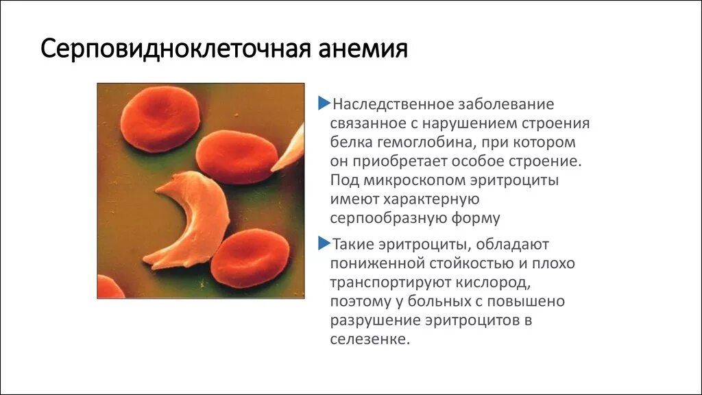 Гемоглобин s при серповидноклеточной анемии. Строение гемоглобина при серповидноклеточной анемии. Серповидно клеточная анемия картина крови. Серповидная анемия эритроциты. Серповидно клеточная анемия признаки