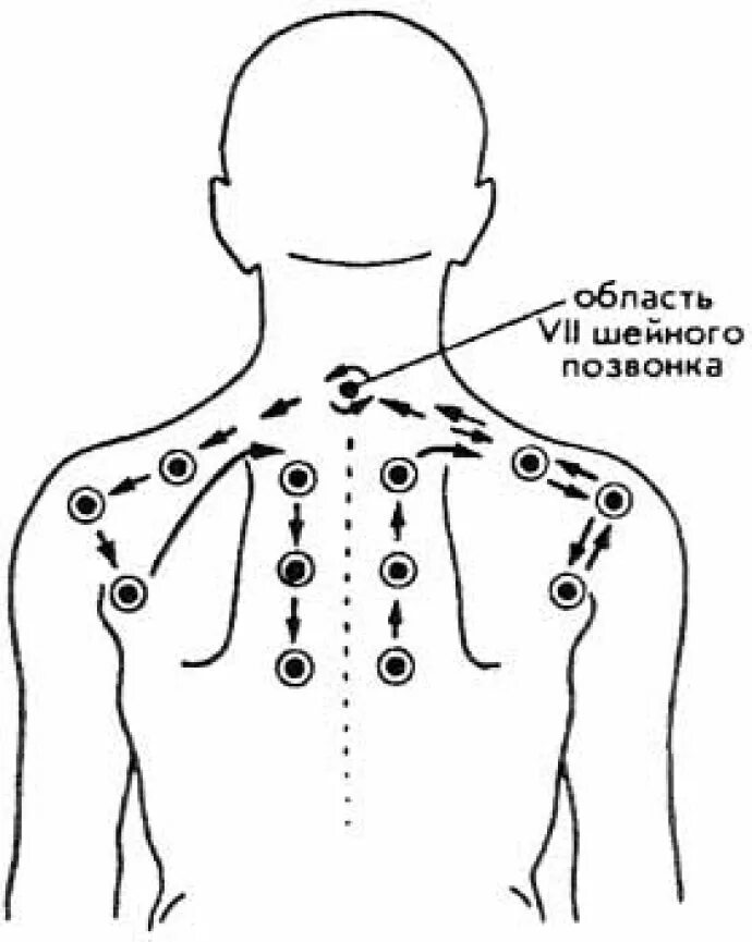 Банки при болях в спине. Баночный массаж спины схема. Схема постановки вакуумных банок. Баночный массаж спины схема постановки банок. Схема шейно воротниковой зоны.