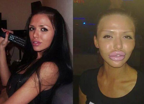 Утиные губы после увеличения. Утиные губы после увеличения. Накачивание губ до и после. Утиные губы после увеличения. Увеличенные губы большие.