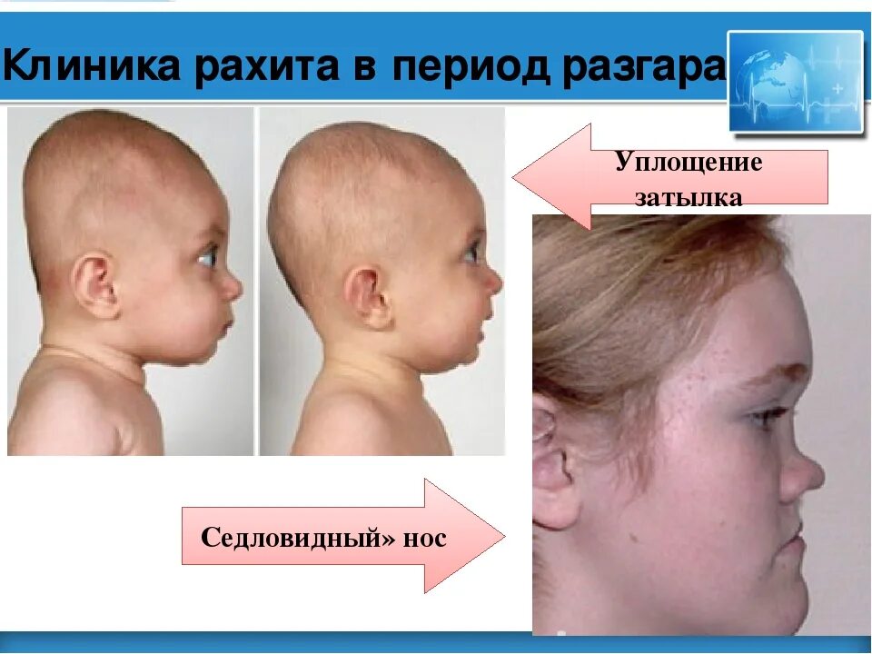Как выглядит рахит у детей. Изменение черепа при рахите.