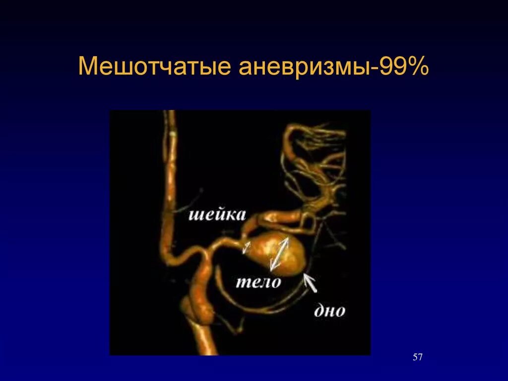 Мешотчатая аневризма внутренней
