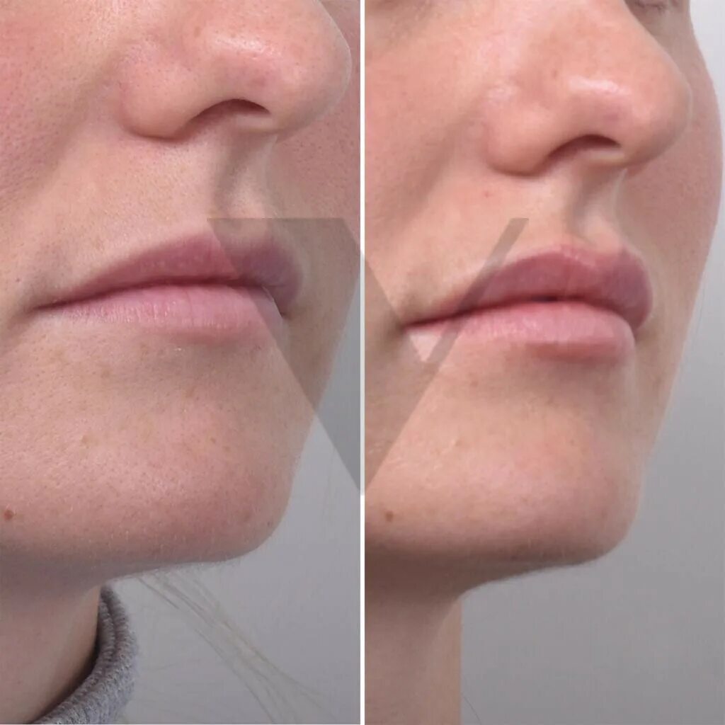 филлер полностью рассосался