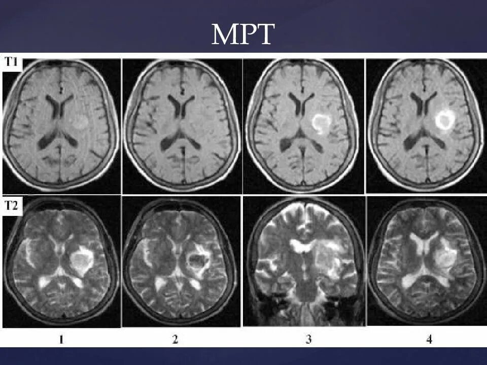 Ишемические изменения головного мозга. Мрт ишемический инсульт т1. ОНМК геморрагический инсульт. ОНМК по ишемическому типу кт. Стадии ишемического инсульта на кт.