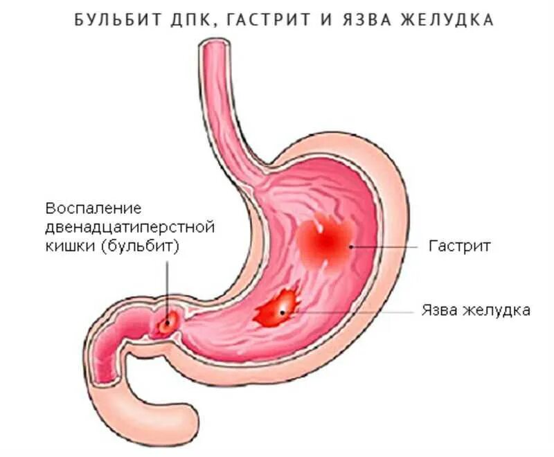 Язвенная болезнь желудка и 12-перстной кишки. Гастрит.. Гастрит 12 перстной кишки. Аоспплнние 12 перстноц кишкт. Гастродуоденит эрозивный бульбит. Лечение язвенного гастрита