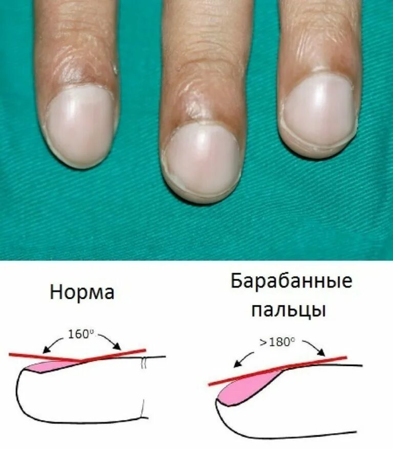 Симптом часовых. Симптом &quot;барабанные палочки и часовые стекла&quot;. пальцы в форме барабанных палочек. симптом барабанных палочек и часовых стекол. барабанные палочки пальцы гиппократа.