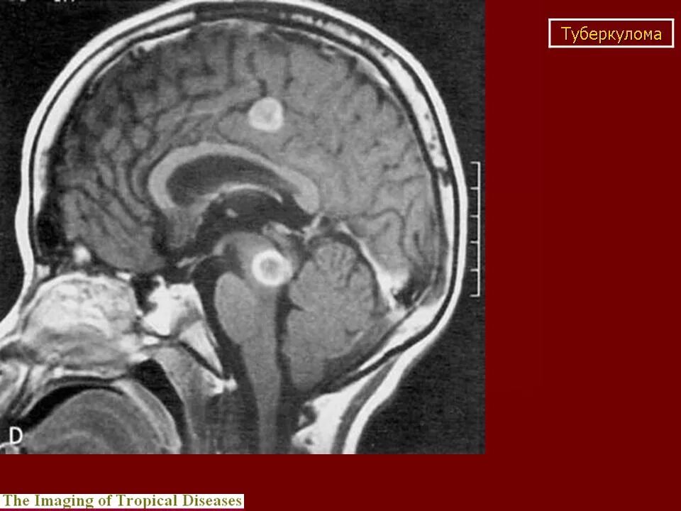 Туберкулема головного мозга на кт. Туберкулез головного мозга кт.