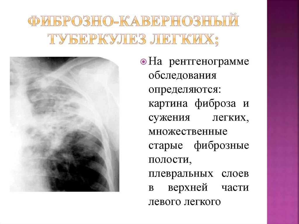 Фиброз легких врач. Каверна туберкулез рентген. Кавернозный туберкулез рентгенография. Фиброзно-кавернозный туберкулез рентген. Фиброзно-кавернозный туберкулез препарат.