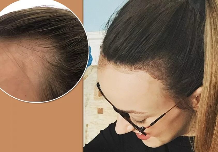 появляются залысины у женщин. залысины на голове у женщин. экозависимая алопеция. залысина на макушке у женщин.