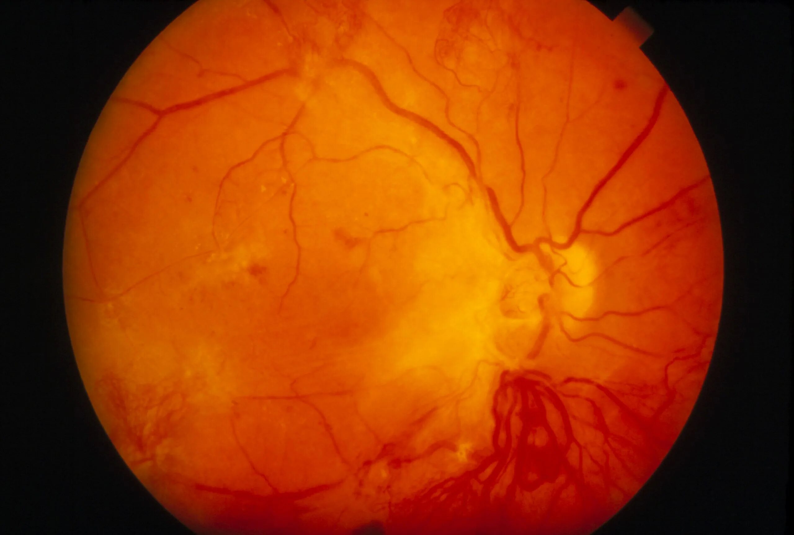 Препролиферативная ретинопатия. Диабетическая ретинопатия. Диабетическая ретинопатия отслойка сетчатки. Пролиферативная и непролиферативная ретинопатия. Диагноз сетчатки