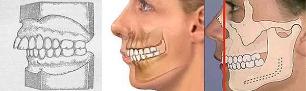 перекрестный прикус брекеты. ортогнатическая хирургия дистальный прикус. дистальный прикус челюсти. дистальный и мезиальный прикус. ортогнатическая хирургия.