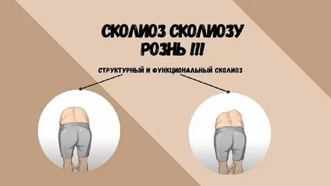 Инфантильный сколиоз это