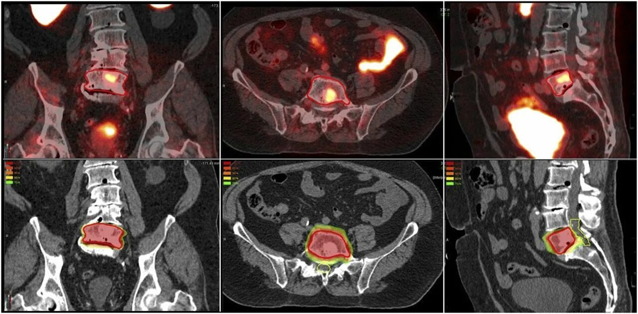 ПЭТ кт предстательной железы с ПСМА 68. ПЭТ/кт Discovery Pet/CT 610.