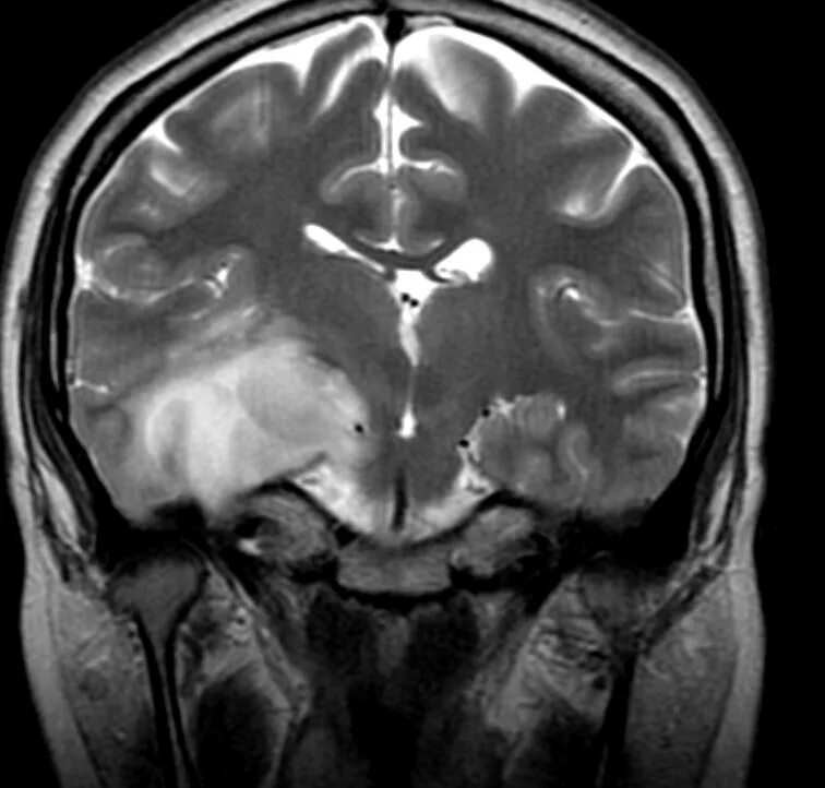 Отек мозга g 93.6 причина. Фибриллярная астроцитома головного мозга. Опухоль головного мозга снимок мрт.