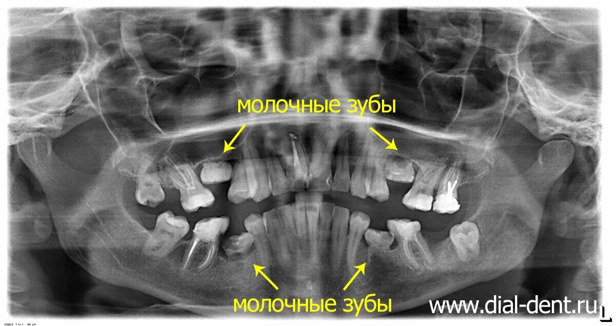 Снимок зубов видное. Панорамный снимок зубов кариес. Рентген молочных зубов. Рентгеновские снимки молочных зубов. Зачатки постоянных зубов.
