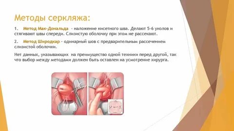 Швы при ицн